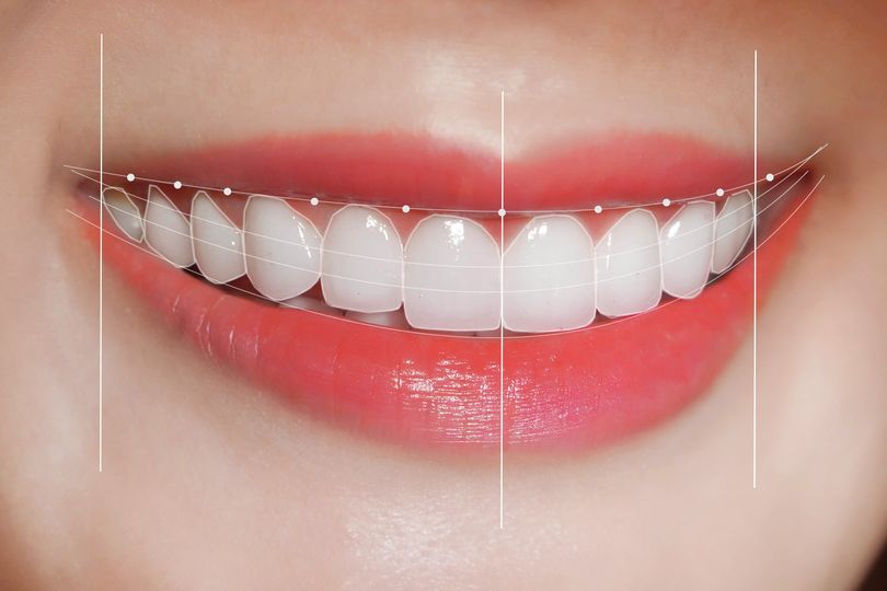 Hàm răng đẹp chuẩn Y khoa là như thế nào?